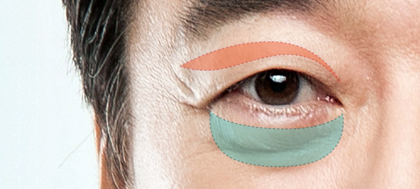 blepharoplasty korea - Blepharoplasty