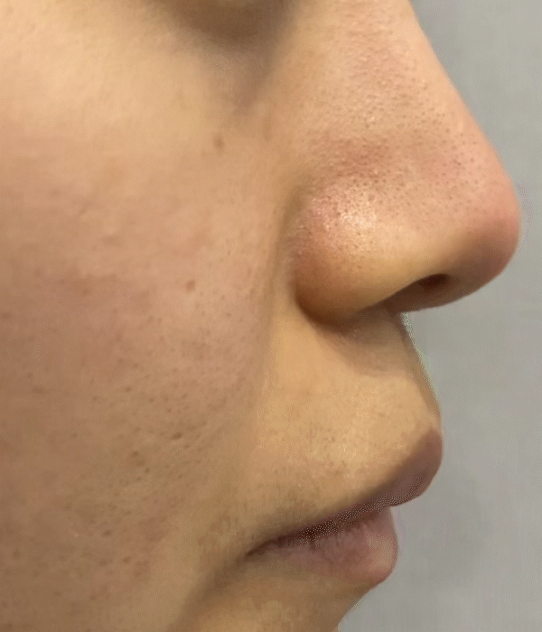 nose tip hardness revision rhinoplasty in korea