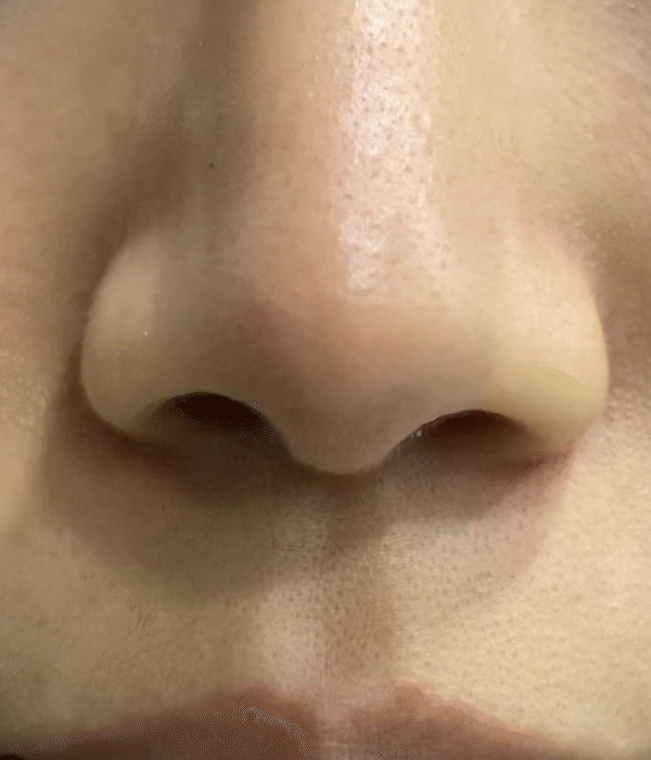 nose tip hardness revision rhinoplasty in korea