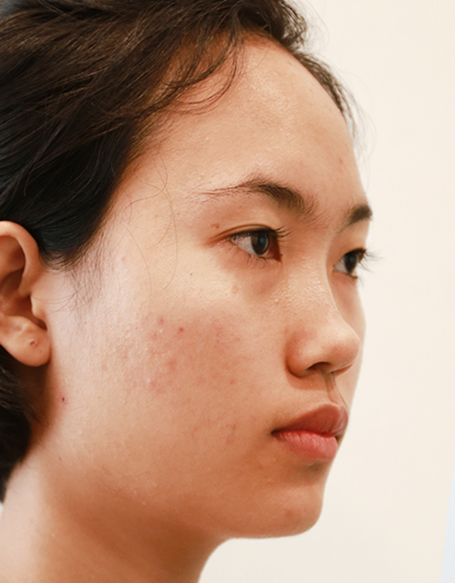 contour nose surgery korea - Contour Nose