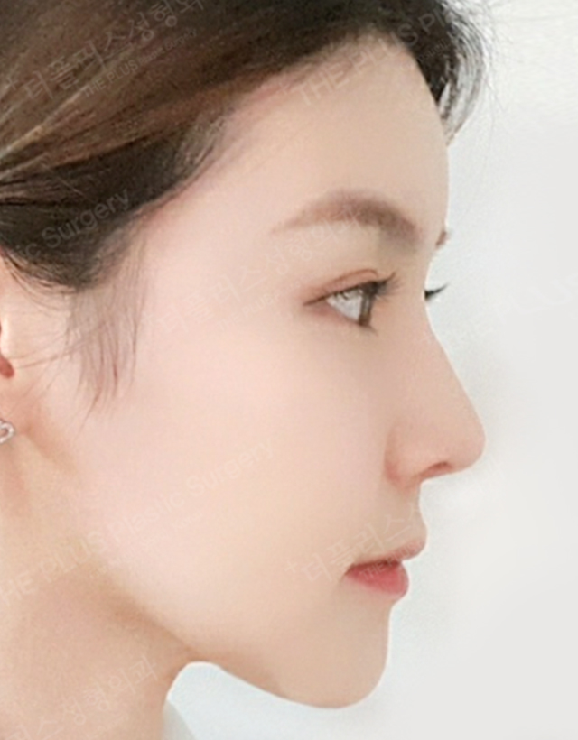 contour nose surgery korea - Contour Nose