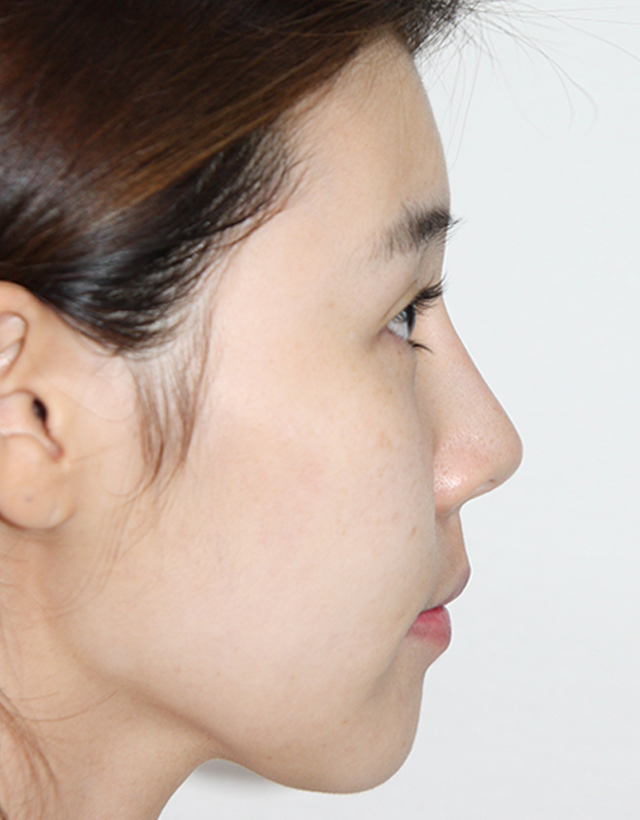 contour nose surgery korea - Contour Nose