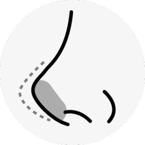 hawk nose surgery korea - Hawk Nose