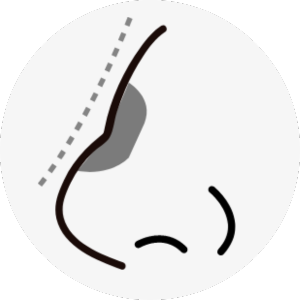 hawk nose surgery korea - Hawk Nose