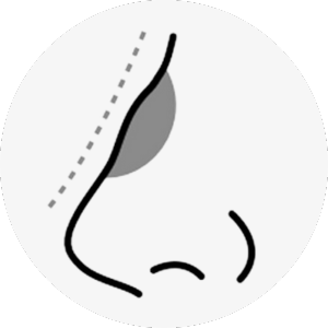 hawk nose surgery korea - Hawk Nose