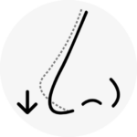 droopy nose surgery korea - Droopy Nose Surgery