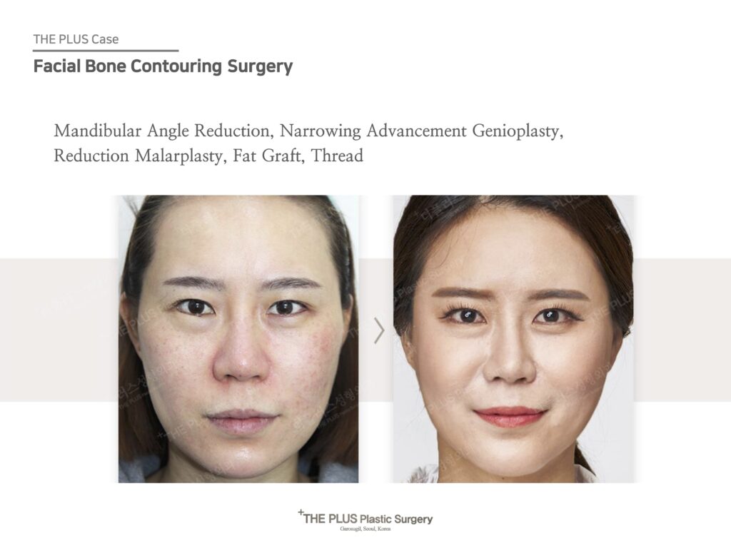 健康・医学 facial bone contouring surgery facial-bone-contouring-