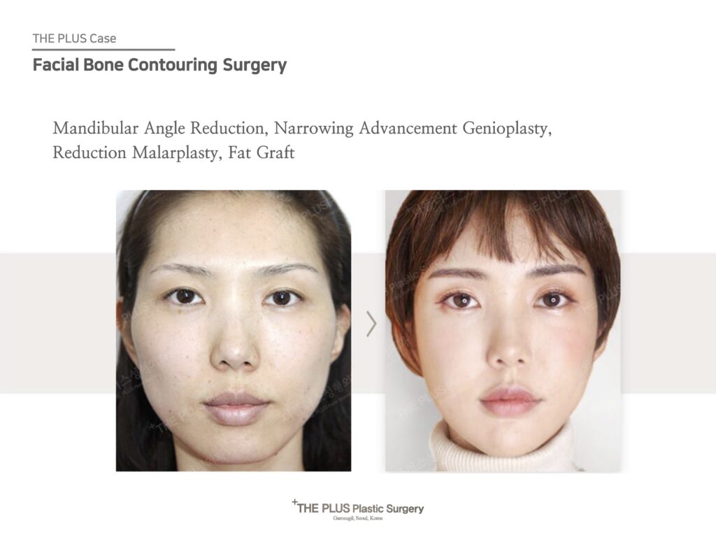 Face Contouring in Korea - The Plus Plastic Surgery in Gangnam