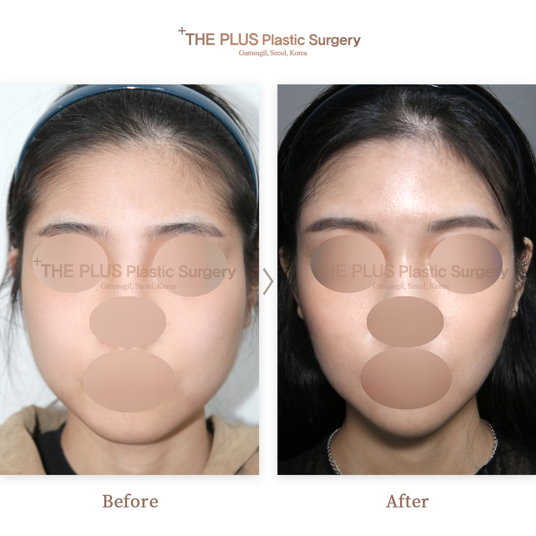 3 combo-face-contouring-face-fat-grafting