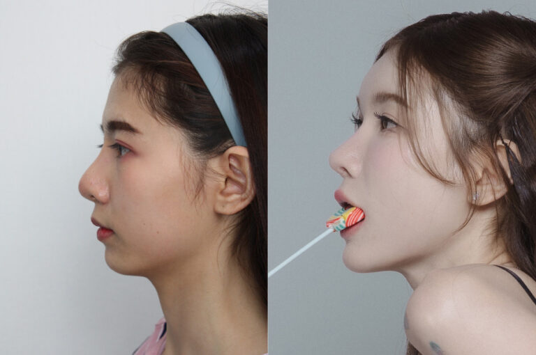 Intira’s Real Review | Eyes, Nose, and Chin Surgery at ThePlus