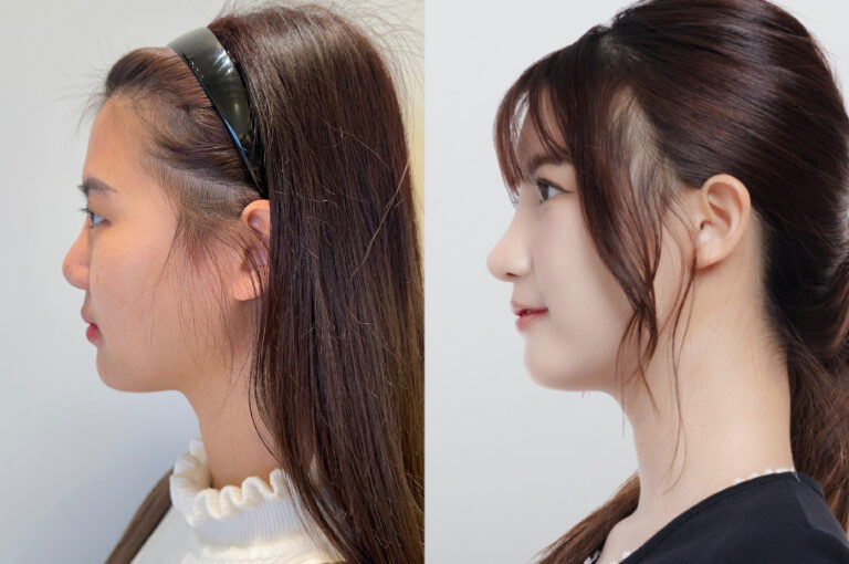 Moonpear’s Real Review | Subtle Yet Beautiful Changes with Nose, Eyes, and Fat Grafting at ThePlus