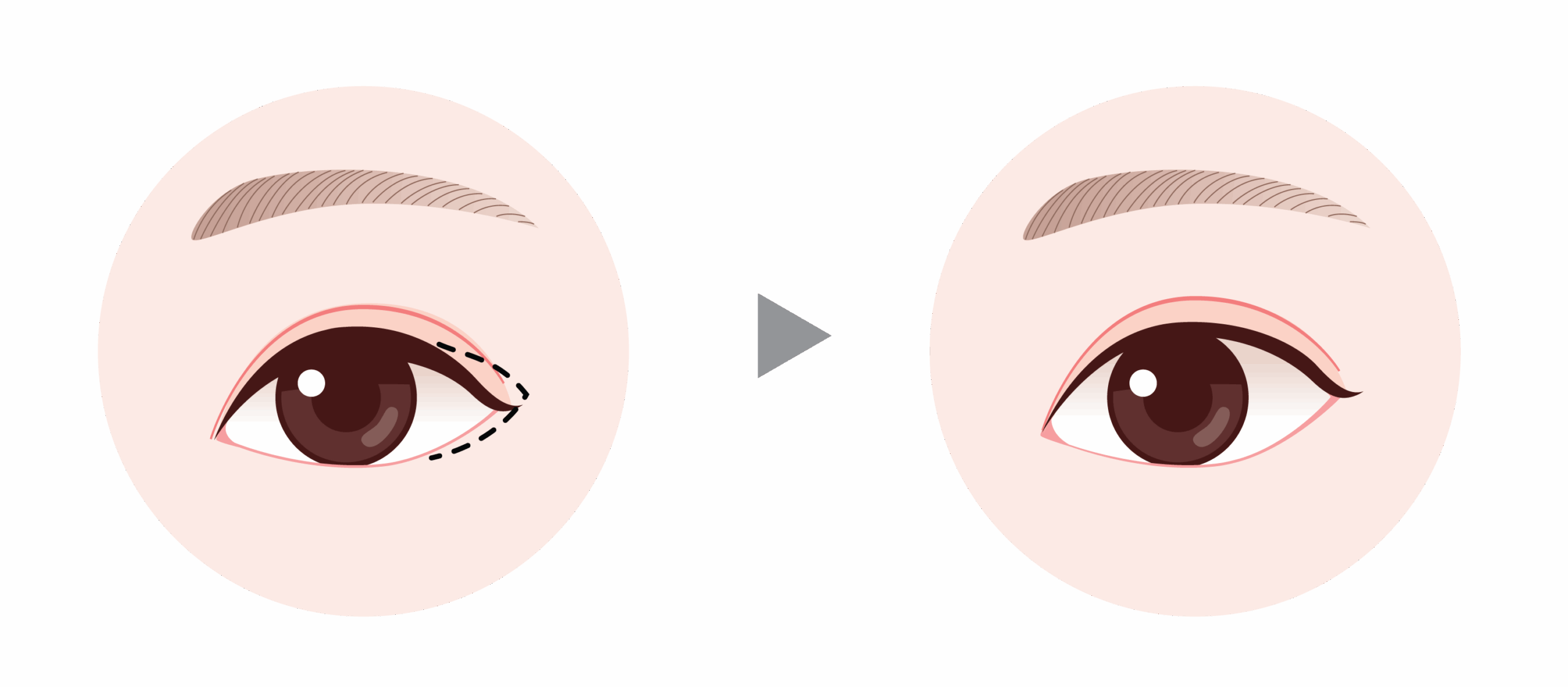 canthoplasty in Korea the plus plastic surgery gangnam