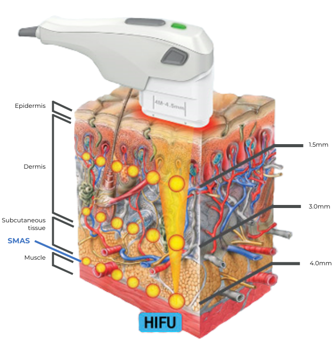 hifu laser lifting in Korea the plus plastic surgery gangnam